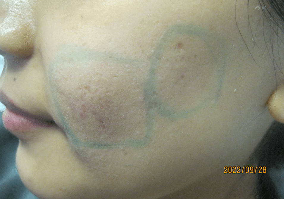 acne scar before subcision procedure