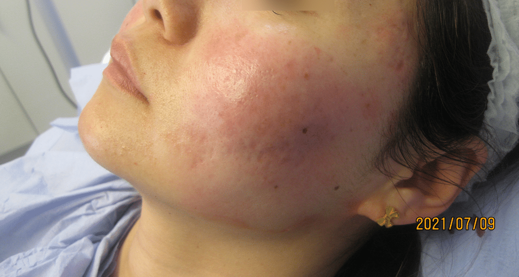 Atrophic acne scarring after treatment