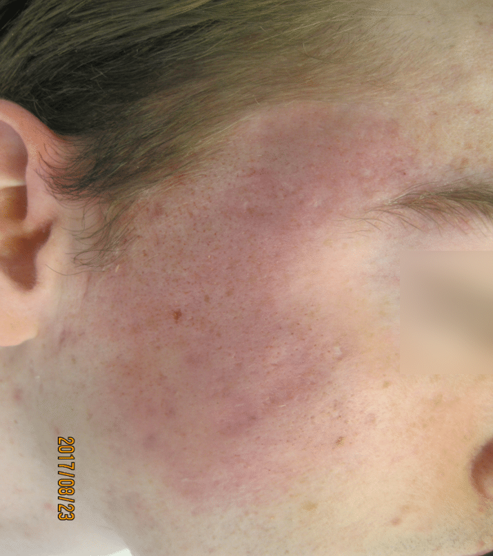 Deep atrophic acne scarring after treatment