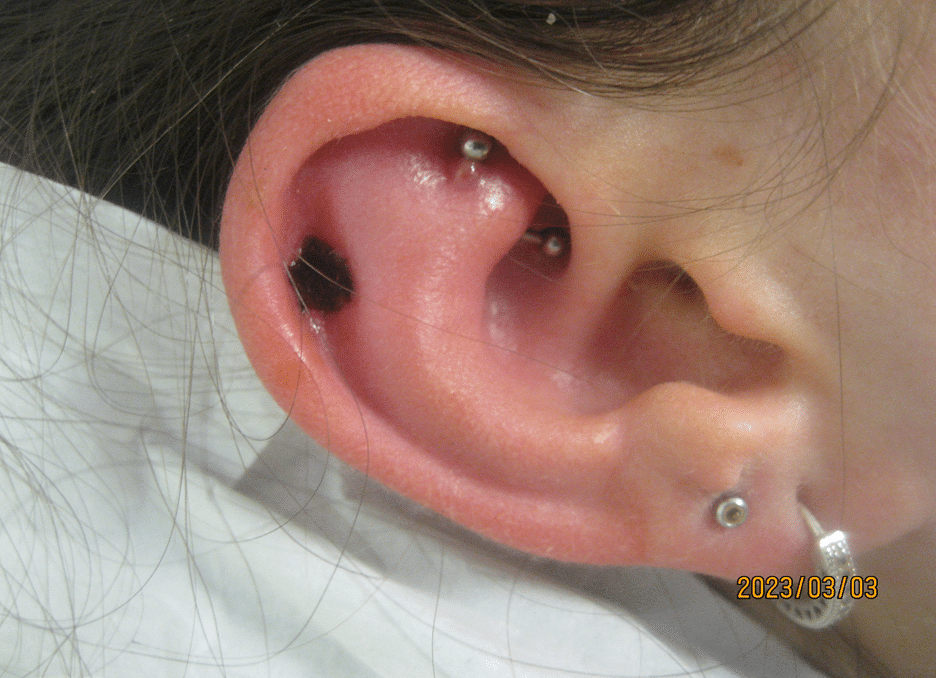 Keloid to ear after treatment