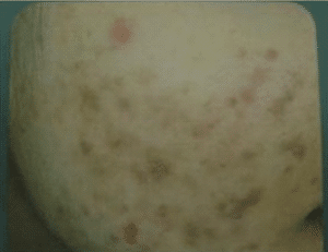 post inflammatory acne pigmentation scarring