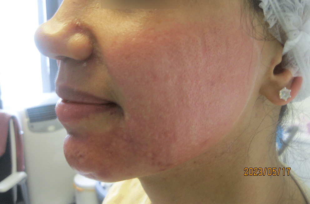 subscision and radiofrequency microneedling and laser for acne scarring