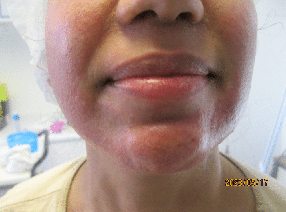 After subscision, radiofrequency microneedling and laser