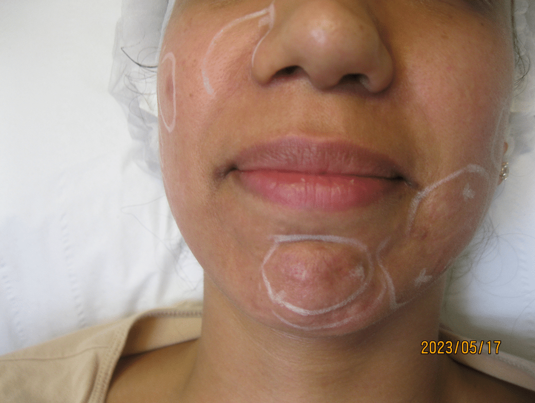 subscision and radiofrequency microneedling and laser before