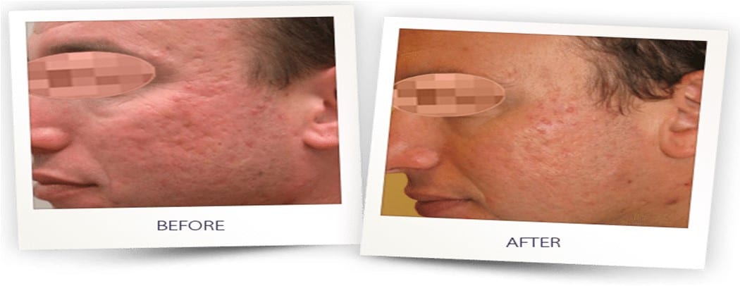 before and after erbium laser for acne scarring