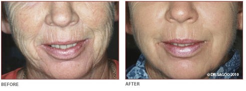 co2 laser resurfacing for fine lines