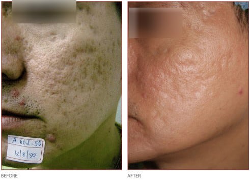 laser resurfacing for acne before and after picture