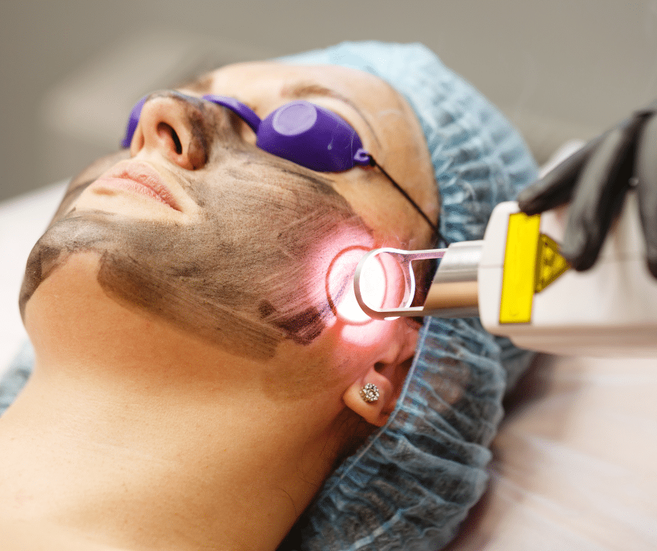 laser resurfacing for acne treatment