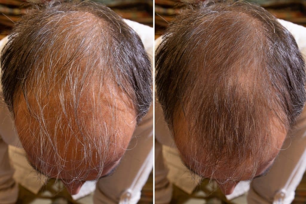 Before and After PRP and carboxytherapy treatment for hair loss