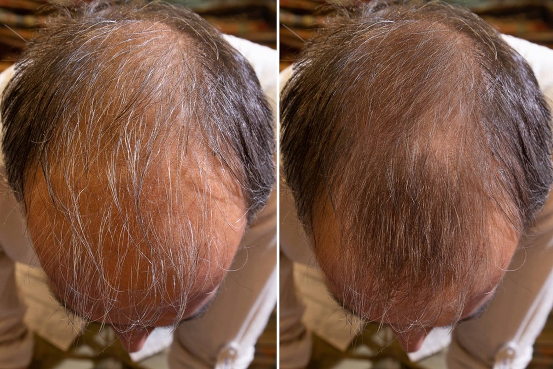 Before and After PRP and carboxytherapy treatment for hair loss