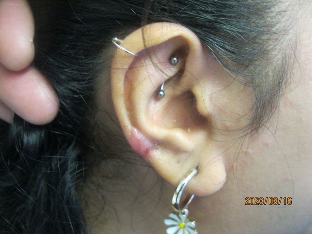 keloid treatment on ear - after