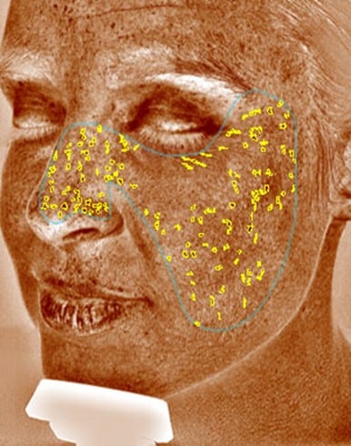 Visia skin analysis for melasma treatment 2