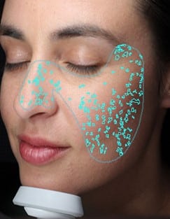 Visia skin analysis for melasma treatment