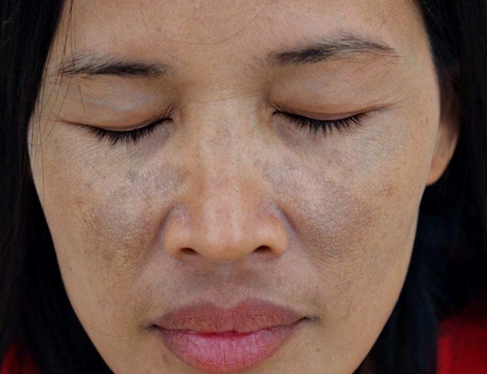 asian girl with melasma on her cheeks and around mouth