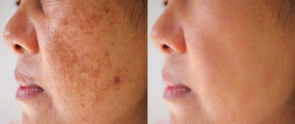 before and after melasma treament at Solihull Cosmetic clinic