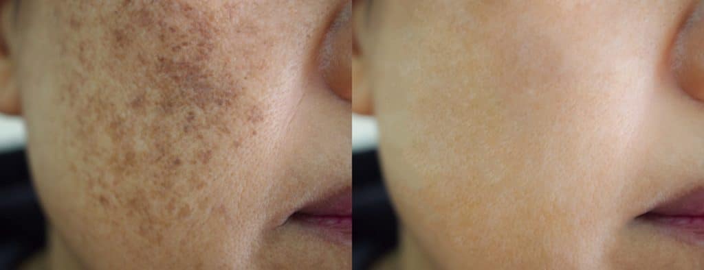 Before and After Melasma Treatment at Solihull Medical Cosmetic Clinic