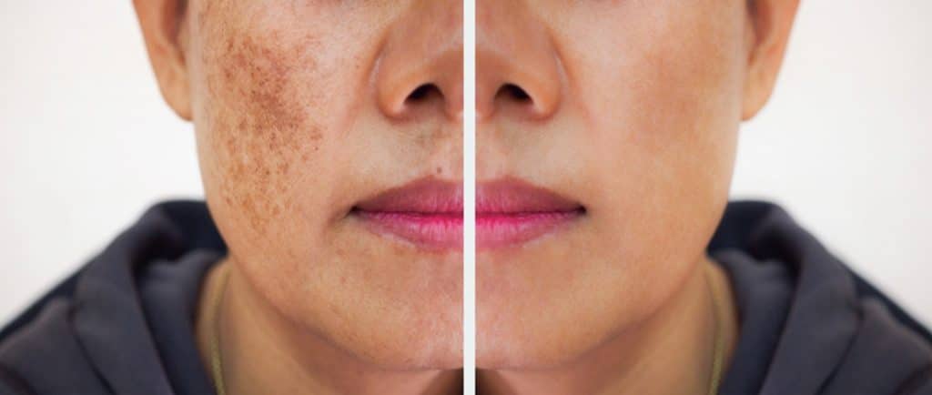 before and after melasma treatment