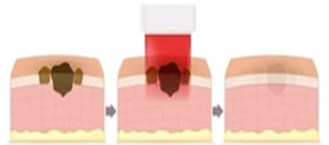 melasma treament with pico laser