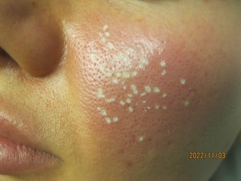 TCA Cross treatment for acne scars at Solihull Medical Cosmetic Clinic