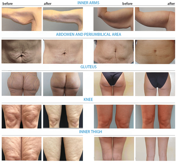 Before and after of endolaser across different body parts