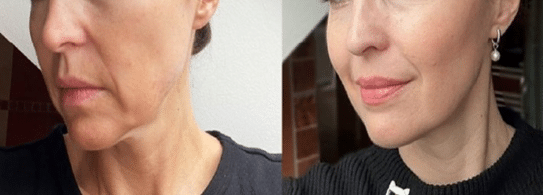 example of before & after endolaser treatment