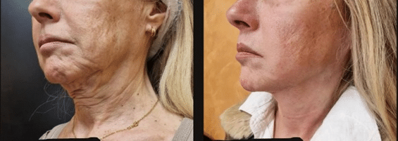 endolaser before & after example