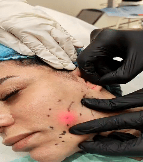 client receiving endolaser treatment