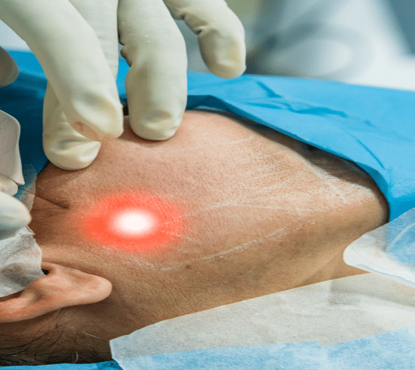 endolaser facelift laser treatment