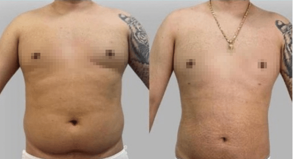 upper body endolaser before and after