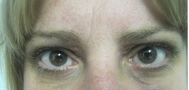 4 Week Review After Treatment
