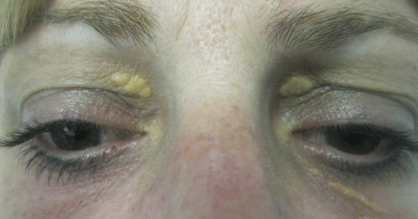 Before Xanthelasma Treatment