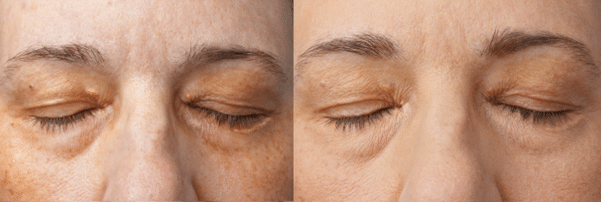 before and after xanthelasma treatment 1