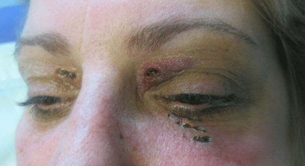 Immediately After Laser Treatment