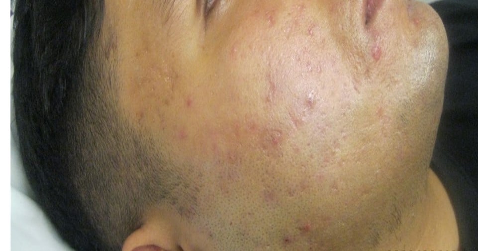 after ASSD treatment