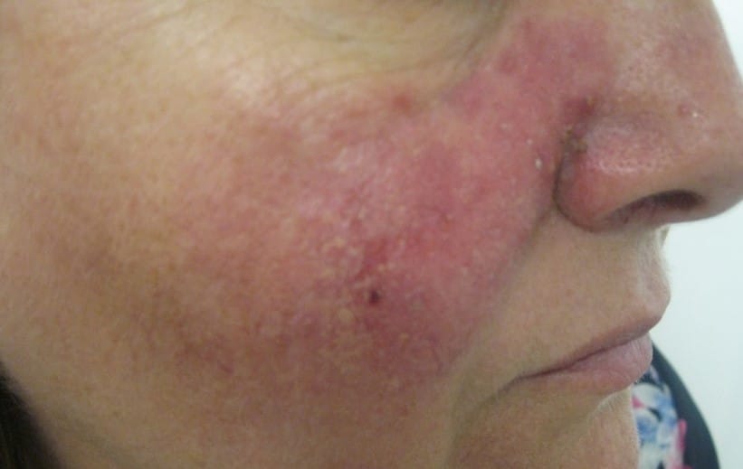 after excimer laser treatment sessions