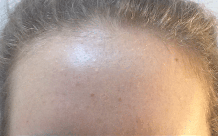 after result from follicle extraction treatment sessions
