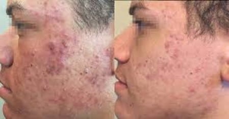 before & 9 months after ASSD