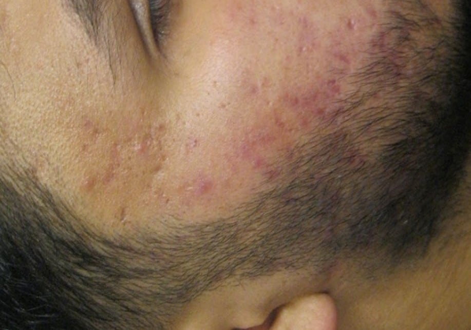 before ASSD treatment