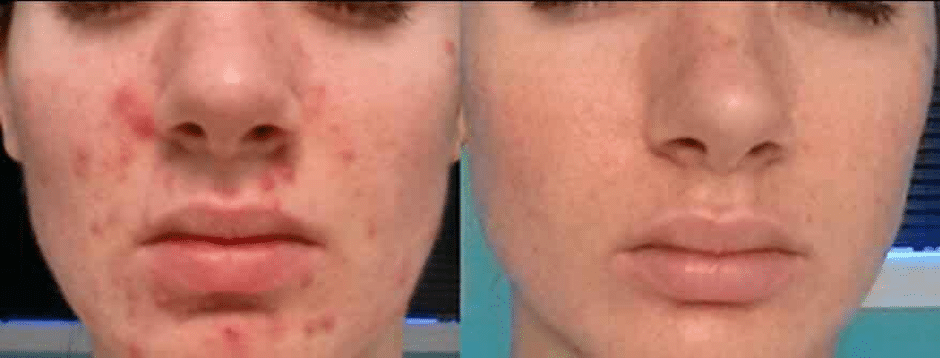 before & after acne laser treatment
