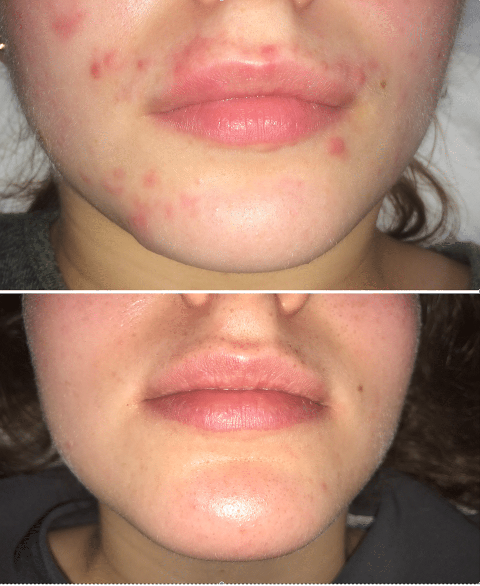 before & after acne peel and LED therapy combination