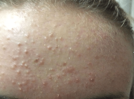 before follicular plugging