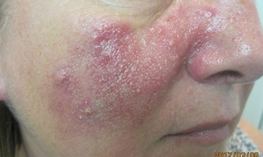 inflammatory acne before treatment