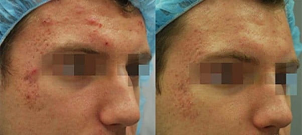 before & after fractora active acne treatment