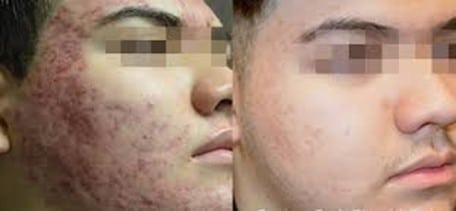 before & after superior duo treatment for acne scarring