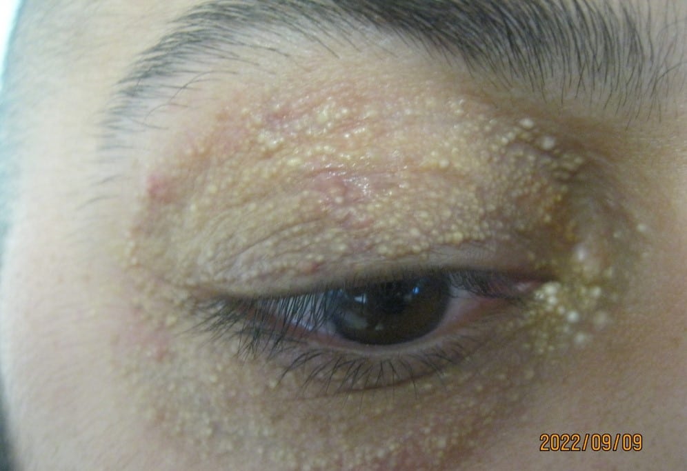 Syringoma pic 1