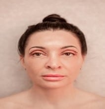 After Endolaser and CO2 Laser Treatment