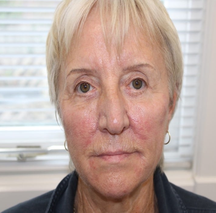 5 Weeks after Endolaser and CO2 Laser Treatment
