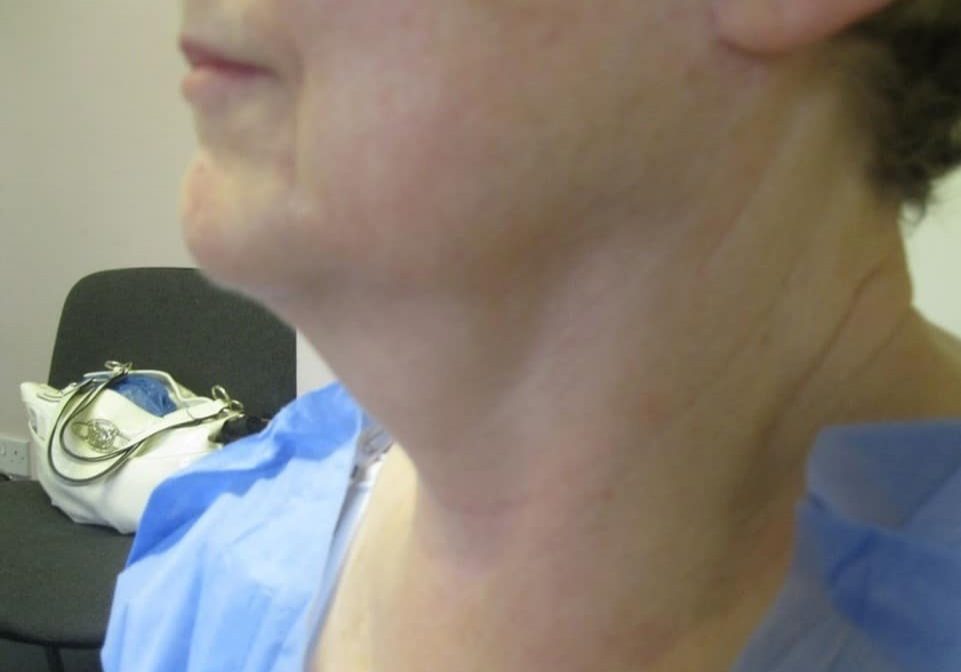 1 - Before necktite liposuction - side2