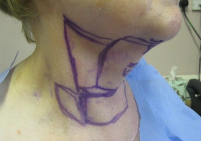 1 - necktite liposuction procedure - side