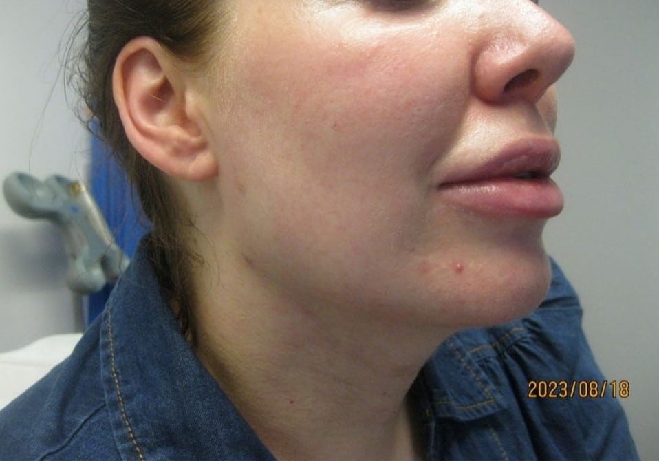 2 - After necktite liposuction - 5 weeks - side